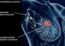 Chirurgia del SENO mininvasiva. Prima Struttura privata a Legnago