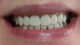 Il sorriso del futuro: come le faccette dentali stanno rivoluzionando l’odontoiatria estetica